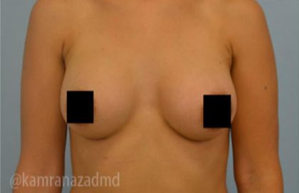 Breast Augmentation Before & After Patient #2130