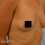 Breast Augmentation Before & After Patient #2130