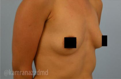 Breast Augmentation Before & After Patient #2130