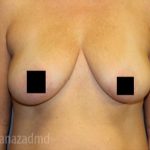 Breast Augmentation Before & After Patient #2131