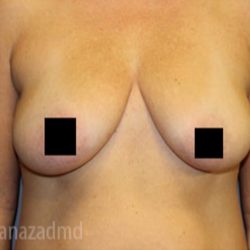 Breast Augmentation Before & After Patient #2131