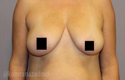 Breast Augmentation Before & After Patient #2131