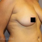 Breast Augmentation Before & After Patient #2131
