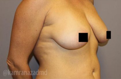 Breast Augmentation Before & After Patient #2131