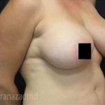 Breast Augmentation Before & After Patient #2131