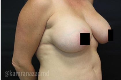 Breast Augmentation Before & After Patient #2131