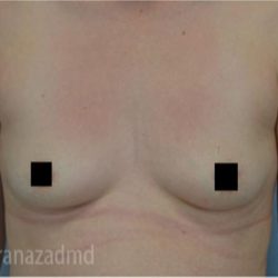 Breast Augmentation Before & After Patient #2132