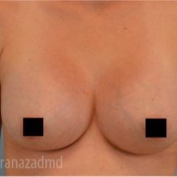 Breast Augmentation Before & After Patient #2132