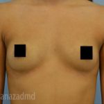 Breast Augmentation Before & After Patient #2133