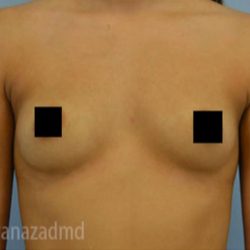 Breast Augmentation Before & After Patient #2133