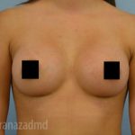 Breast Augmentation Before & After Patient #2133