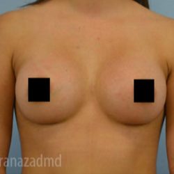 Breast Augmentation Before & After Patient #2133