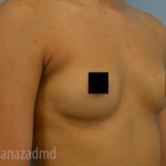 Breast Augmentation Before & After Patient #2133