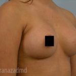Breast Augmentation Before & After Patient #2133
