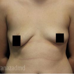 Breast Augmentation Before & After Patient #2134