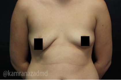 Breast Augmentation Before & After Patient #2134