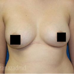 Breast Augmentation Before & After Patient #2134
