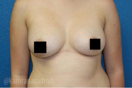 Breast Augmentation Before & After Patient #2134