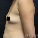 Breast Augmentation Before & After Patient #2134