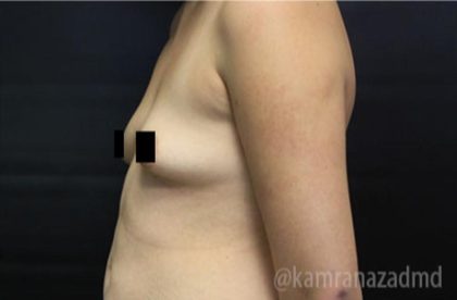 Breast Augmentation Before & After Patient #2134