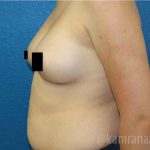Breast Augmentation Before & After Patient #2134