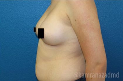 Breast Augmentation Before & After Patient #2134