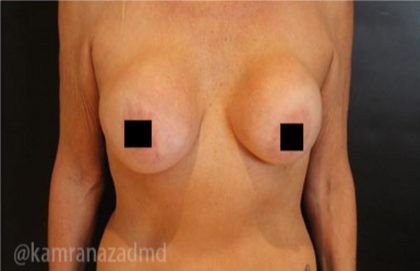 Breast Augmentation Before & After Patient #2135