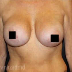 Breast Augmentation Before & After Patient #2135