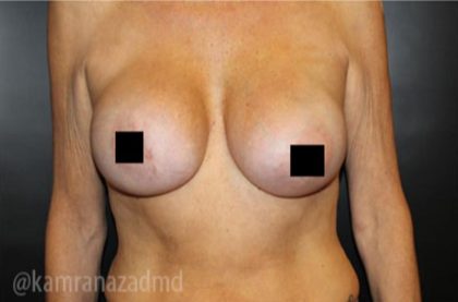 Breast Augmentation Before & After Patient #2135