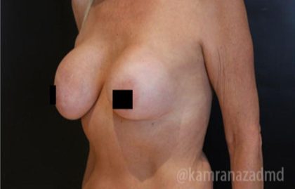 Breast Augmentation Before & After Patient #2135