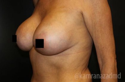 Breast Augmentation Before & After Patient #2135