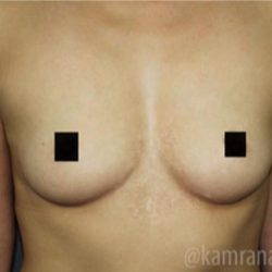 Breast Augmentation Before & After Patient #2117