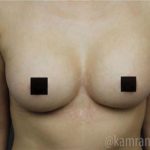 Breast Augmentation Before & After Patient #2117