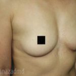 Breast Augmentation Before & After Patient #2117