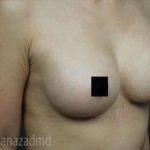 Breast Augmentation Before & After Patient #2117