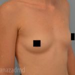 Breast Augmentation Before & After Patient #2136