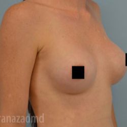 Breast Augmentation Before & After Patient #2136