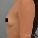 Breast Augmentation Before & After Patient #2136