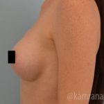 Breast Augmentation Before & After Patient #2136