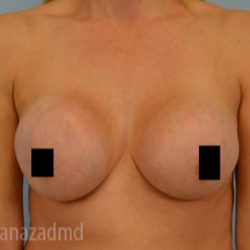 Breast Augmentation Before & After Patient #2137