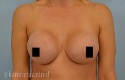 Breast Augmentation Before & After Patient #2137