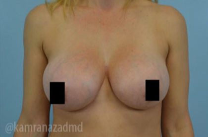 Breast Augmentation Before & After Patient #2137