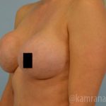 Breast Augmentation Before & After Patient #2137
