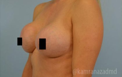 Breast Augmentation Before & After Patient #2137