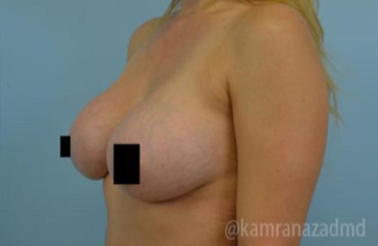 Breast Augmentation Before & After Patient #2137