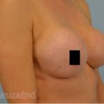 Breast Augmentation Before & After Patient #2137