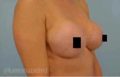 Breast Augmentation Before & After Patient #2137
