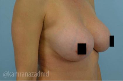 Breast Augmentation Before & After Patient #2137
