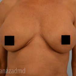 Breast Augmentation Before & After Patient #2138