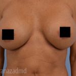 Breast Augmentation Before & After Patient #2138